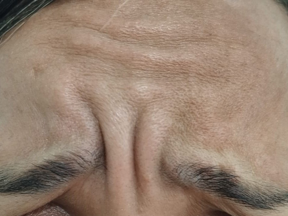 Antes do procedimento